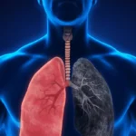 El fármaco de Akeso contra el cáncer de pulmón destaca en los ensayos, impulsando las esperanzas en un mercado de 20.000 millones de dólares